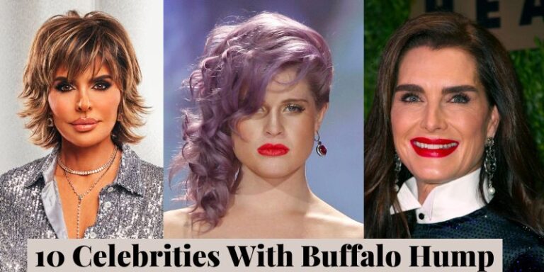 10 Celebrities With Buffalo Hump