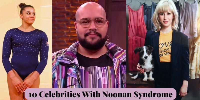 10 Celebrities With Noonan Syndrome
