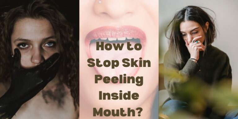 How to Stop Skin Peeling Inside Mouth?