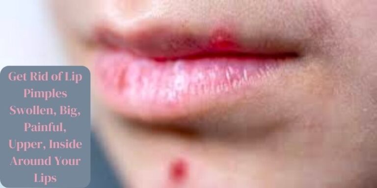 Get Rid of Lip Pimples Swollen, Big, Painful, Upper, Inside Around Your Lips
